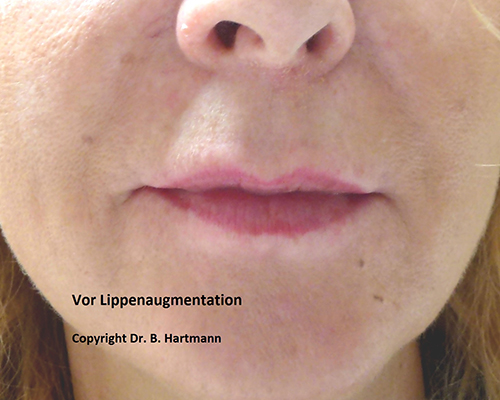 Vor Lippenaugmentation
